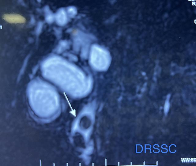 GALL STONE DISEASE WITH BILE DUCT STONES (CHOLEDOCHOLITHIASIS)