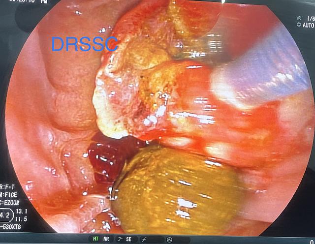 ENDOSCOPIC RETROGRADE CHOLANGIOPANCREATOGRAPHY (ERCP) WITH CBD STONE EXTRACTION FOLLOWED BY LAPAROSCOPIC CHOLECYTECTOMY  (ERCP WITH LAPCHOLE)