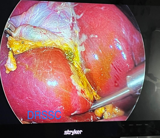 LOST STONE IN THE ABDOMINAL CAVITY