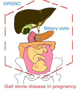 POSTPARTUM AND GALL STONE DISEASE